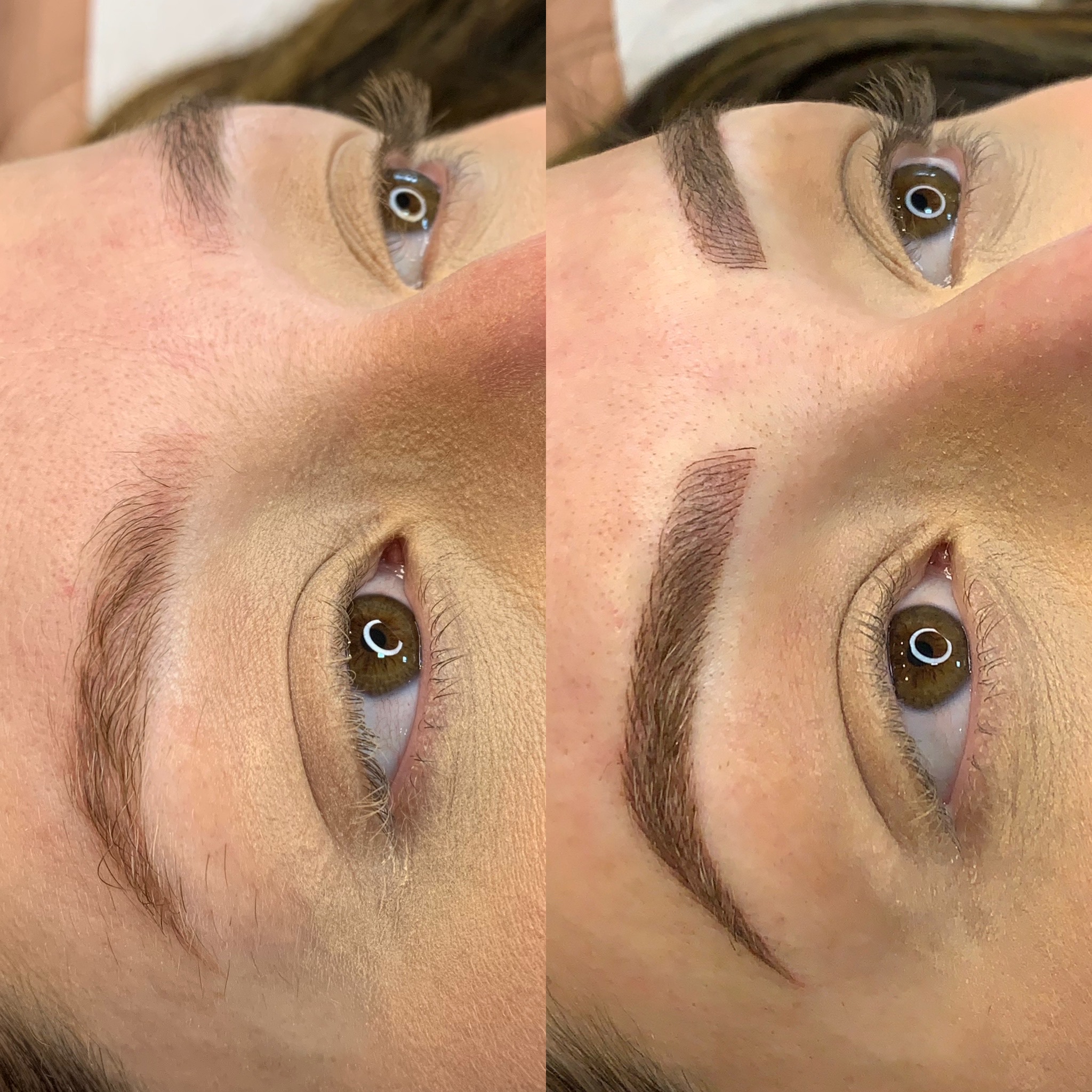 Resultado de remoção a laser